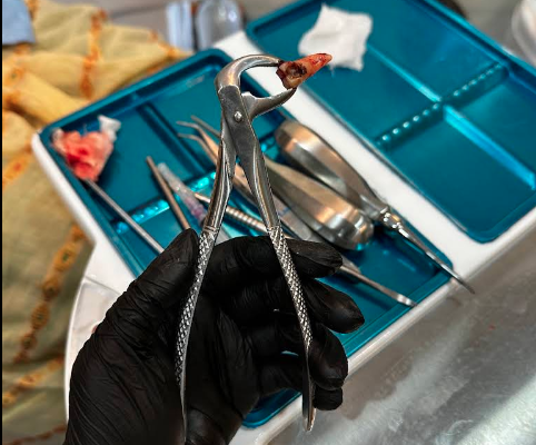 Root Canal Treatment